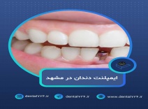 ایمپلنت دندان در مشهد با اقساط بلندمدت و شرایط ویژ
