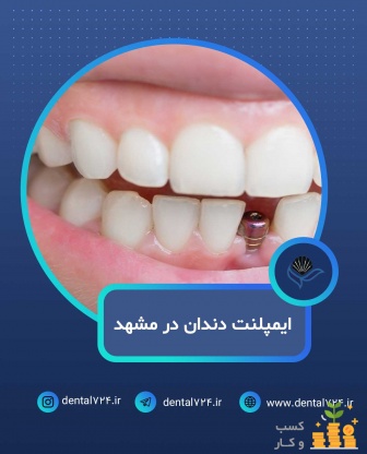 ایمپلنت دندان در مشهد با اقساط بلندمدت و شرایط ویژ