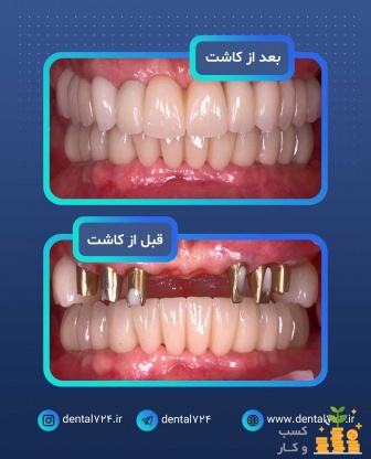 ایمپلنت دندان در مشهد با اقساط بلندمدت و شرایط ویژ